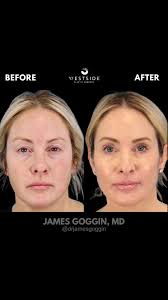 The eyes are where surgical detail matters most. ✨, This patient underwent  an upper blepharoplasty to remove excess skin