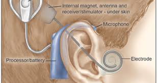 Cochlear Implants Surgery Risks Nyee Cochlear Cochlear Implant Implants