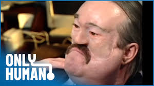 His Face Was Deformed by Flesh- Eating Fungus