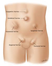 Image result for stomach hernia symptoms