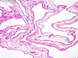 Maybe you would like to learn more about one of these? Webpathology Com A Collection Of Surgical Pathology Images