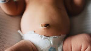Keep the cord clean and dry at all times. The Umbilical Cord Fell Off What Should I Do