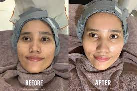 Nah untuk ngilangin komedo, pertama kali aku nyoba produk scrub st ives yg aprikot. Menghilangkan Komedo Dan Bruntusan Dengan Facial Treatment Signature Dpct Deep Pore Cleansing Therapy Di Erha Clinic Medan Agnesiarezita Beauty Blogger Medan
