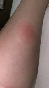 Image result for ant bite