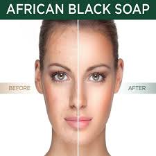 African Black Soap All Natural Best Acne Scar Blemish Blackhead Treatment Cure Walmart Com Walmart Com