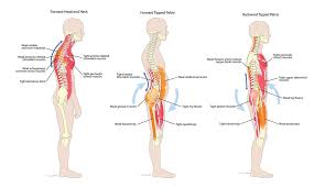The erector spinae is a long, thick muscle mass composed of the smaller and shorter muscle masses of the spinalis, iliocostalis, and longissimus dorsi, which are classified via insertion point. 17 Back Muscles That Cause The Most Back Pain And How To Get Relief