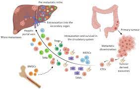 For example, a cancer that is large but has not spread to another body part can also be called Ijms Free Full Text Therapeutic Targeting Of The Tumour Microenvironment In Metastatic Colorectal Cancer