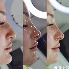 Celebrity Injectors On Instagram Before After Non Surgical Nose Job With Pdo Threadlift Dermal Fillers T Nose Job Nose Plastic Surgery Dermal Fillers