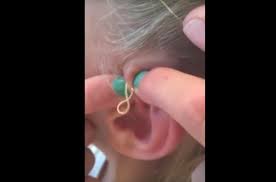 Pimple popper treatment in this ridiculously satisfying video of her 15. Girl Who Popped Giant Six Year Old Pimple Didn T Expect This To Come Out World News Mirror Online
