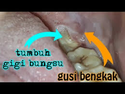 Beberapa kasus memungkinkan anda untuk mengganti pasta gigi sesuai dengan saran dokter. Penyebab Gusi Bengkak Dan Sakit Gigi Bungsu Tumbuh Untung Ga Gusi Bernanah Dokter Gigi Jogja Youtube