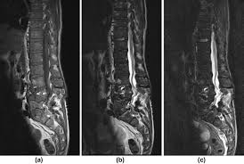 Mri Appearances Of Extramedullary Haematopoiesis Presenting With Cauda Equina Syndrome In Sickle Cell Disease Clinical Radiology