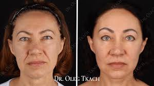 Результати операцій на обличчі