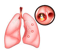 Definitie :introducerea medicamentelor gazoase si volatile prin mucoasa respiratorie. Bronhoscopia Metoda De Diagnostic Si Tratament Importanta In Bolile Respiratorii Reginamaria Ro