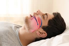 Snoring and sleep apnea