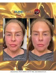 Platelet BioFill (™) (PBF)