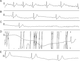 Image result for Exercise Induced Syncope