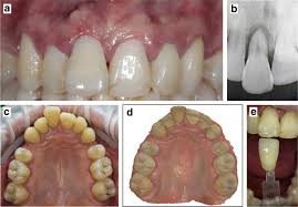 How long does it take to make dentures after impressions. Manufacturing Of An Immediate Removable Partial Denture With An Intraoral Scanner And Cad Cam Technology A Case Report Bmc Oral Health Full Text