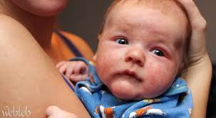 7 نصائح ستساعدك في التخلص من حكة الاكزيمة ويب طب