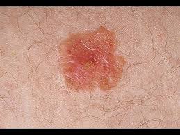 Skin Cancer On The Rise In U S Kids Youtube