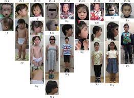 After besi dies, rika finds out and attacks ishmael. Temple Syndrome Comprehensive Molecular And Clinical Findings In 32 Japanese Patients Abstract Europe Pmc