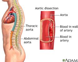 Aortic Dissection Medlineplus Medical Encyclopedia Your doctor may recommend abdominal aortic aneurysm (aaa) repair to treat an aneurysm.