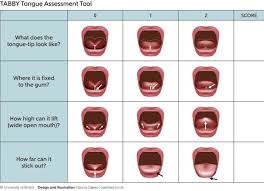Image result for Ankyloglossia