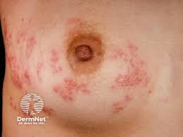 Image result for zoster under breasts