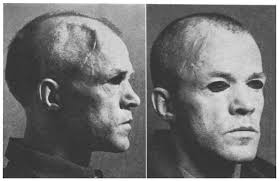 USE OF TANTALUM FOR FACIAL AND CRANIAL DEFECTS