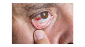 Image result for Scleritis