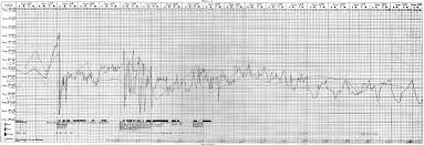 File Rheumatic Fever Temperature Chart Wellcome M0018835 Jpg