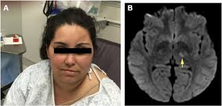 Ischemic Stroke in a Patient with Parry–Romberg Syndrome