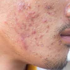 Clay, cactus, cucumber, etc.) for different purposes: 6 Kiat Mengatasi Jerawat Batu Pada Wajah