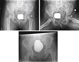 Image result for Pediatric Limp