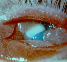 Image result for Conjunctivitis