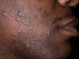 Most black men are likely to develop ingrown hair aftershave. Ingrown Beard Hairs Skin Disorders Msd Manual Consumer Version