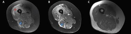 Combined thigh and calf involvement were present in 10% of patients. Muscle Mri For Neuromuscular Disorders Practical Neurology