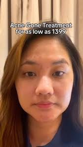 Why treat acne?, Here’s why:, 👍without treatment, dark spots and permanent  scars can appear