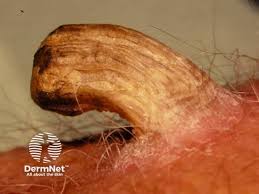 Image result for cornu cutaneum)