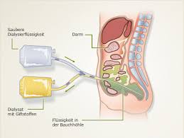 Bei schäden der nieren sind alle diese bereiche früher oder später betroffen. Abnehmende Nierenleistung Muss Ich Zur Dialyse Gesundheitsliebe