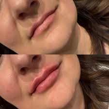 Lydia Olson, RN, BSN (@aesthetics_by_lydia) • Instagram photos and videos