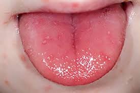 Check out the pictures of hand foot and mouth disease, symptoms, treatment, causes, images, photos and information on coxsackievirus. Hand Foot And Mouth Disease Warning As Children Hit By Wave Of Virus Mirror Online