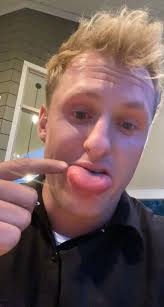 Man films his massively swollen tongue after he was stung by a bee while  eating a burger