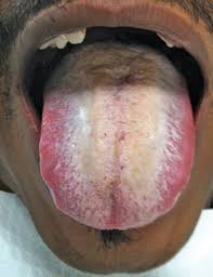 Image result for black hairy tongue symptoms