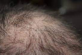 Hair loss and heart disease alopecia, more commonly known as hair loss in men and women, can occur for a variety of reasons and understanding those causes is important to determining treatment options. Is There A Link Between Hair Loss And Heart Disease What To Look For