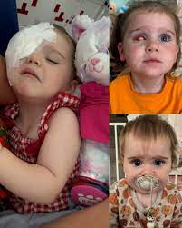 The day Michaela was born should have been pure joy — instead, it brought shock and fear. She entered the world with a 10-centimeter hole in her skull, her brain exposed. Doctors