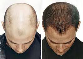 Half of all men have visible hair loss by age 50, and for many men, the process of hair loss can start early in their 20s. Pin On Hair Loss Hair Prevention