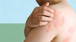 Image result for Hives