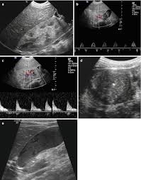 Chronic renal failure in patients on hpn. Acute Renal Failure In Children Abdominal Key
