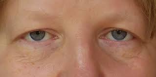 Eyes Reflect Vitality When Three Whites Sanpaku Can Be A Red Flag Rebecca Wood Various famous people have sanpuka eyes. eyes reflect vitality when three