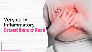 Image result for Inflammatory breast cancer